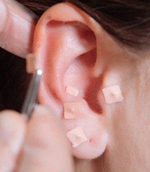 Auriculoterapia thumbnail