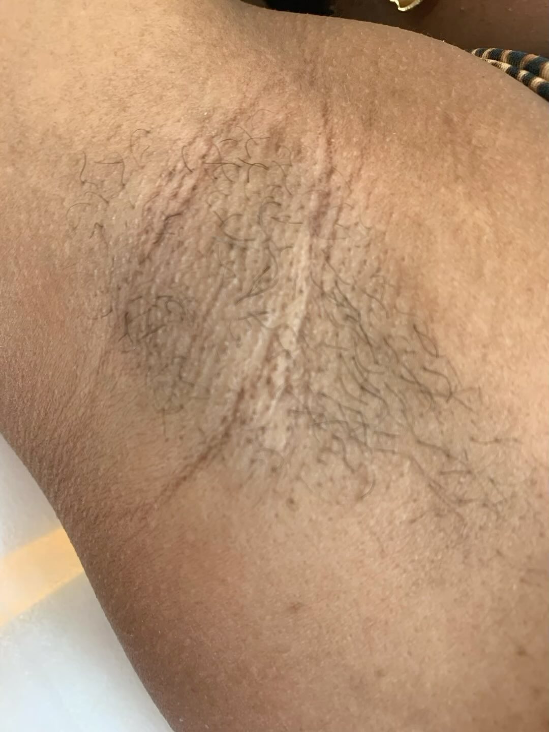 Cliente depilava com gilete a vida inteira e hoje se libertou, vejam esse antes o arranque perfeito e depois#vamosficarl