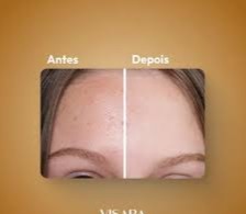 Pele sem espinhas, sonho de toda mulher. Viralizou no tiktok, clique e peça o seu hoje mesmo thumbnail