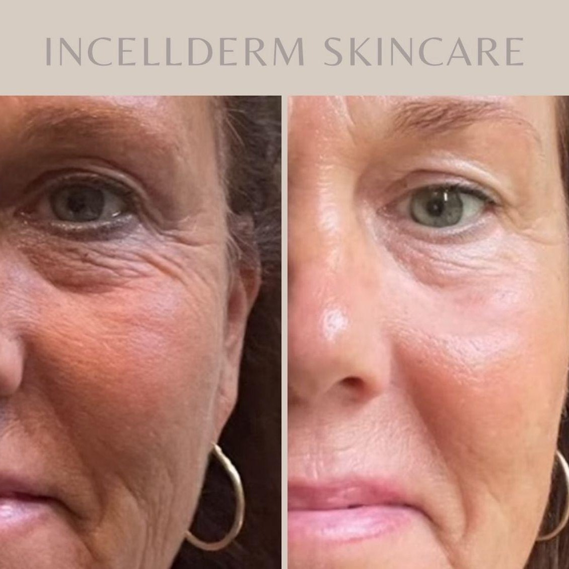 Uneven tone and visible lines thumbnail