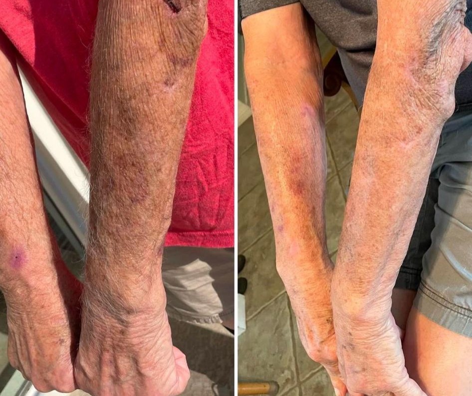 Eczema, itchy dry skin thumbnail