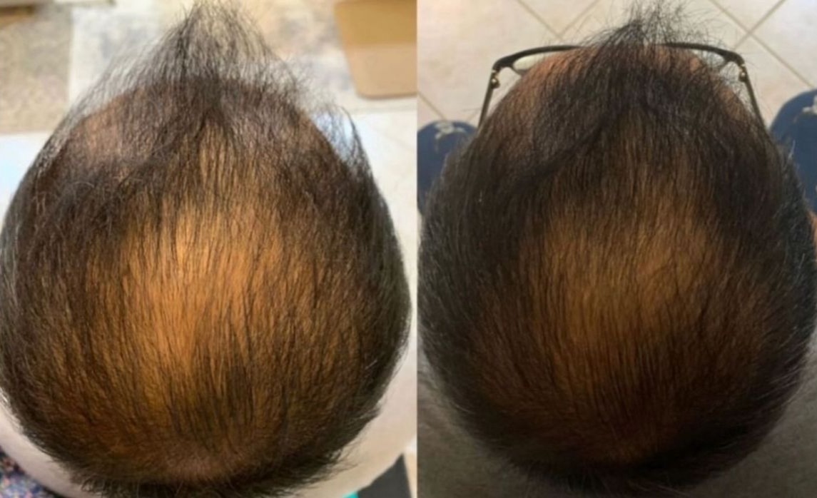 Receding hair line thumbnail