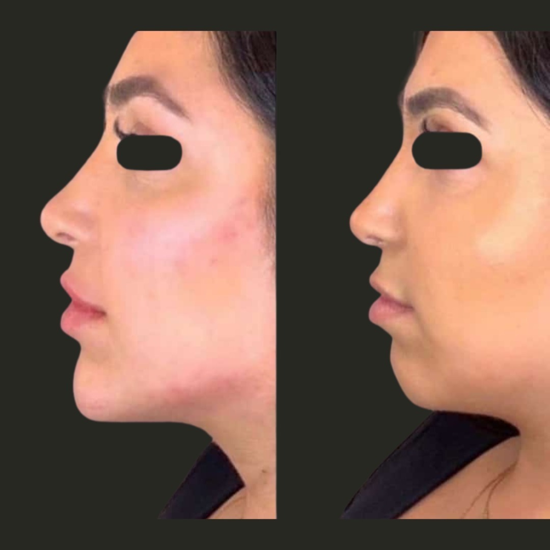 Harmonização Facial thumbnail