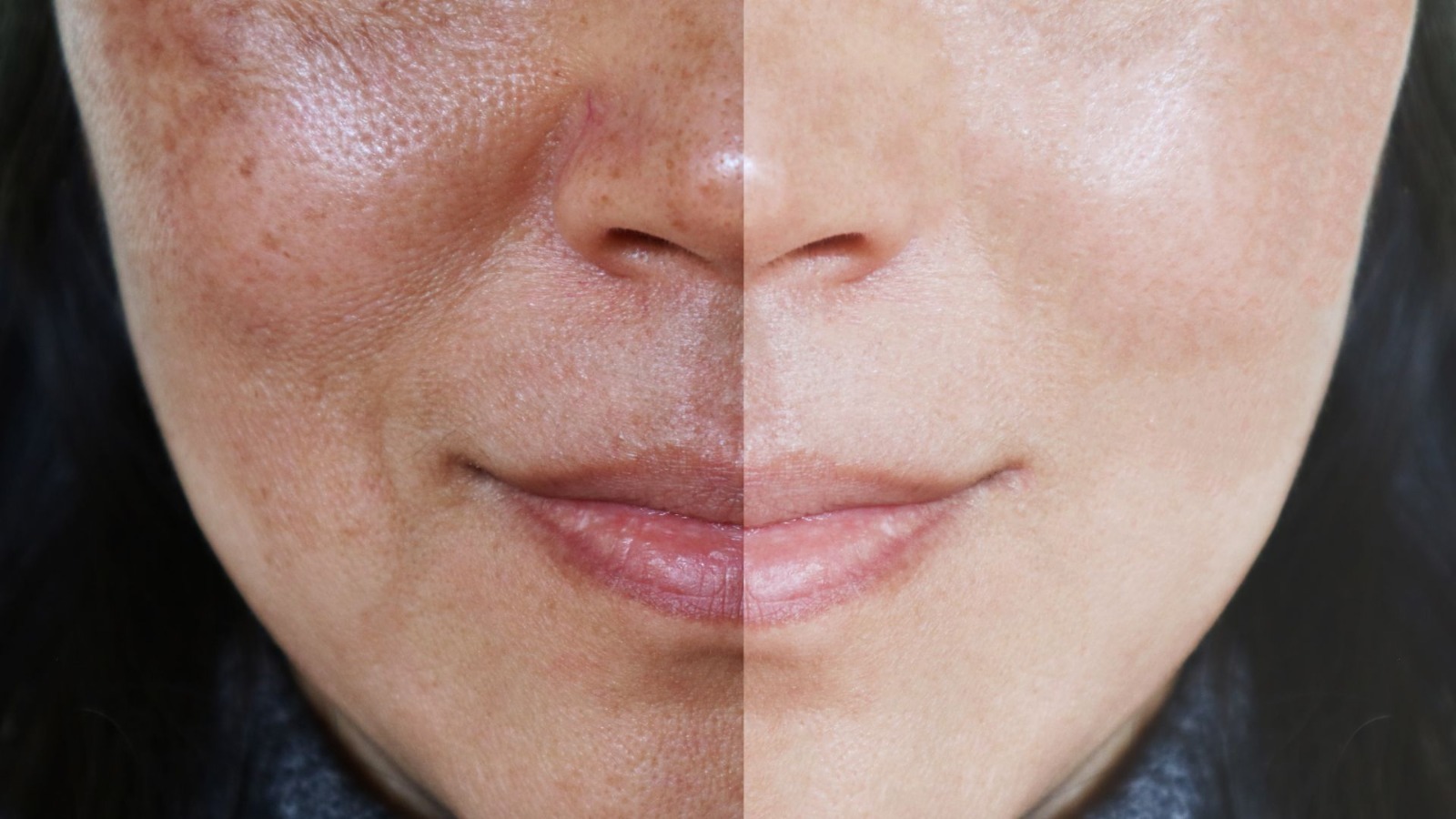 Clareamento Manchas e Melasma thumbnail