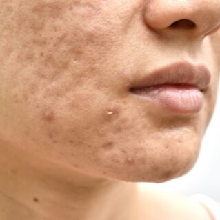 Acne e Sequelas thumbnail