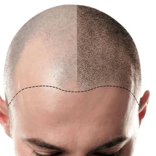 MICROCAPILAR thumbnail