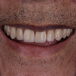 Protocolo sobre implantes thumbnail