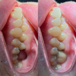 Implantes Unitários thumbnail