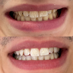 Clareamento Dental thumbnail