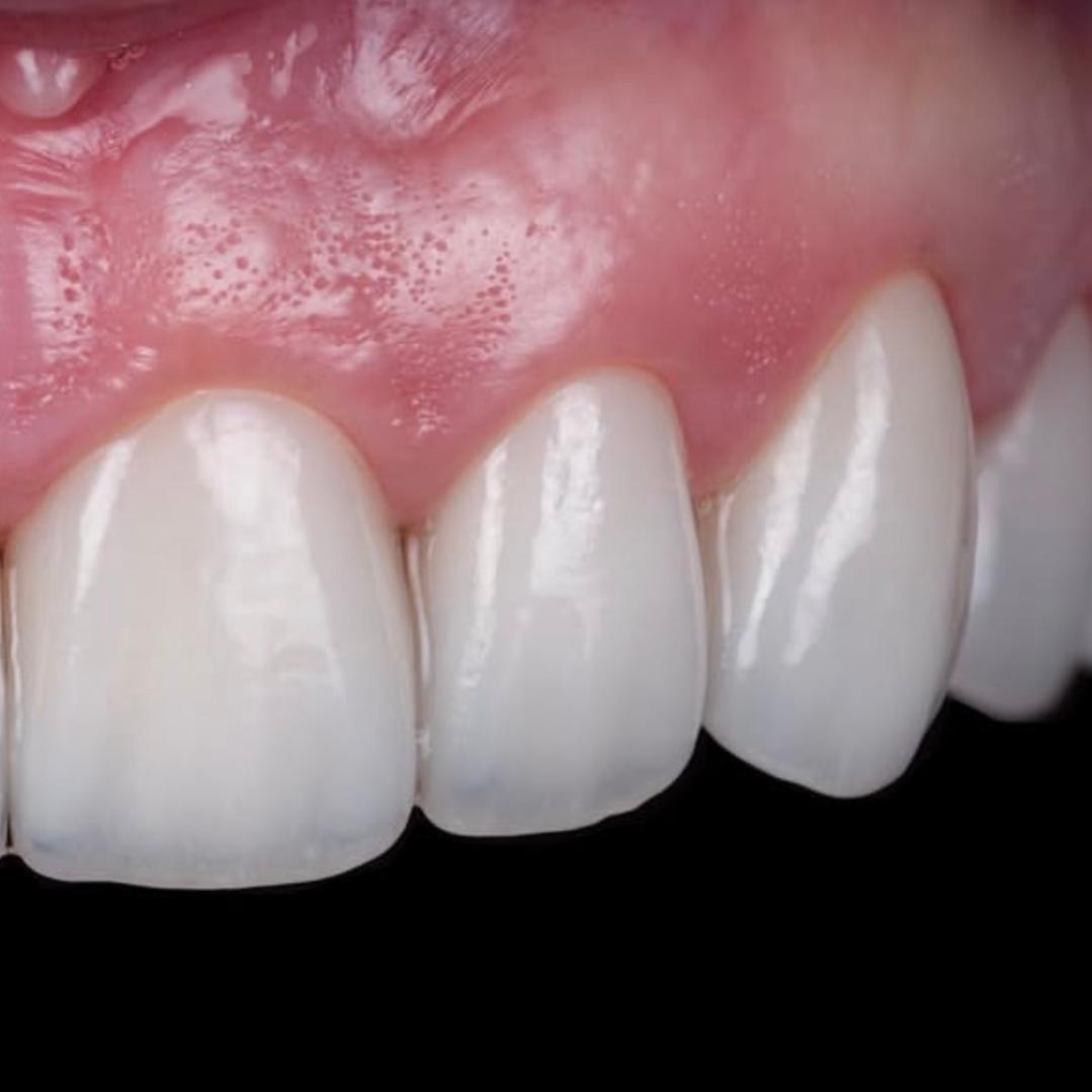 SANTÉ GINGIVALE & PARODONTOLOGIE  thumbnail