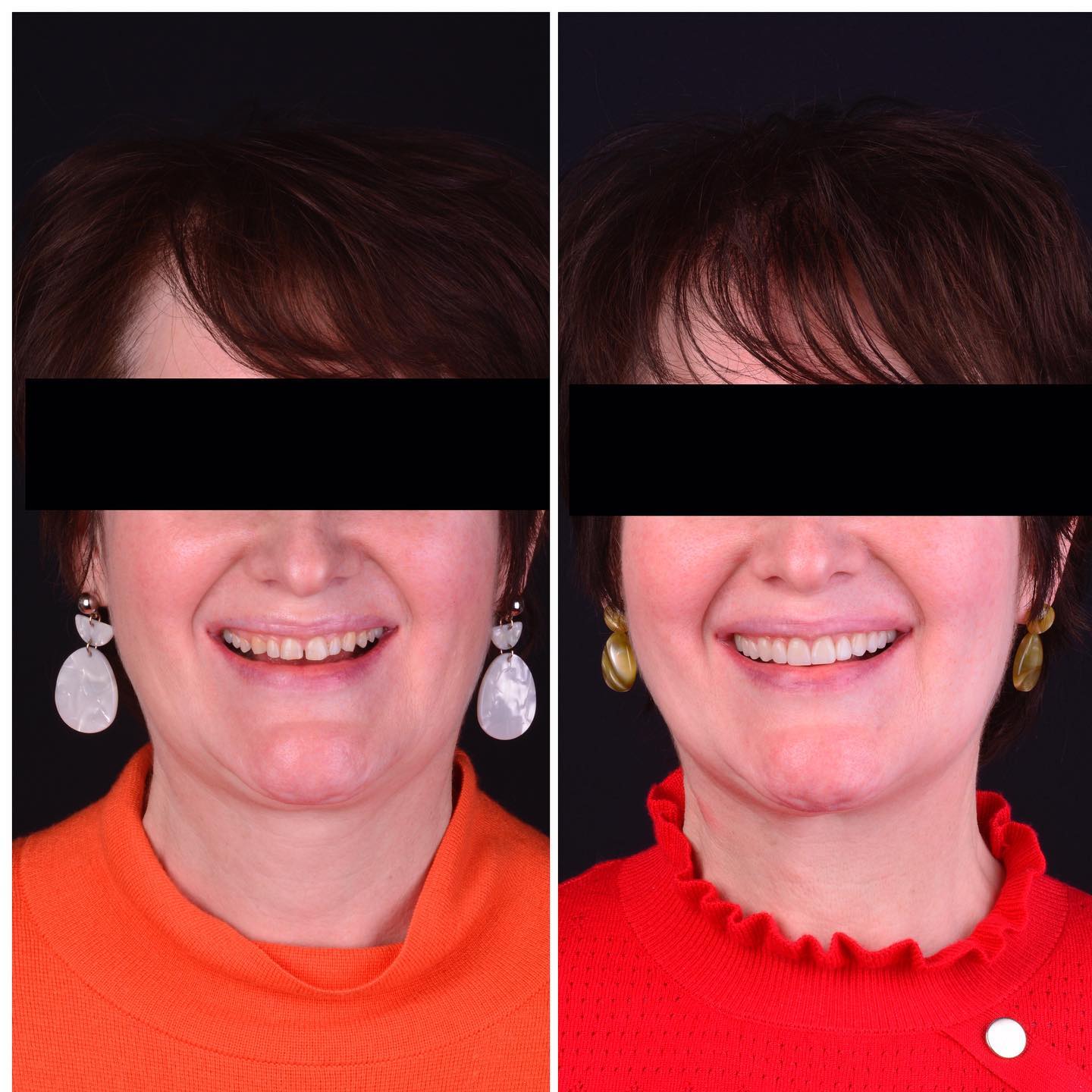 The challenging parts of this Smile Design were to close the diastema without creating a Visual Tension , in other words