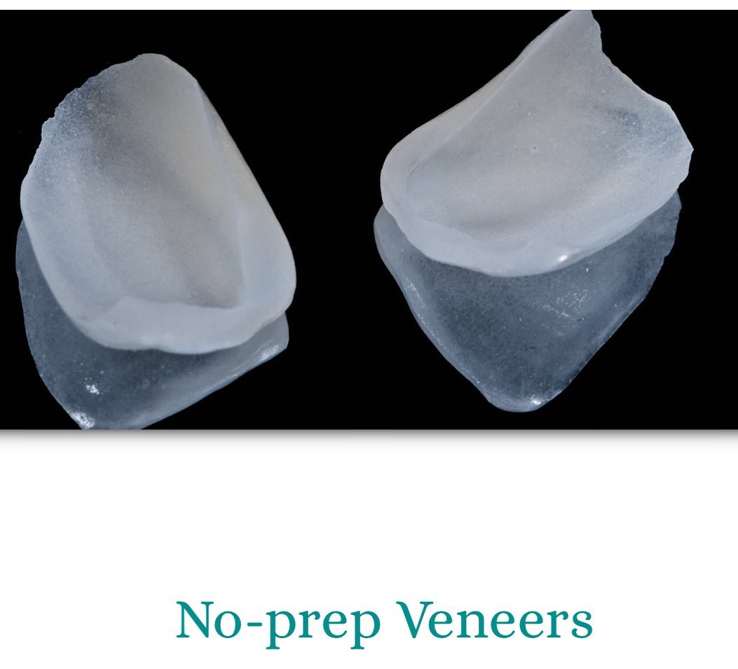 We have the possibility today to bond veneers on teeth that haven’t been prepared. In well diagnosed cases no reduction 