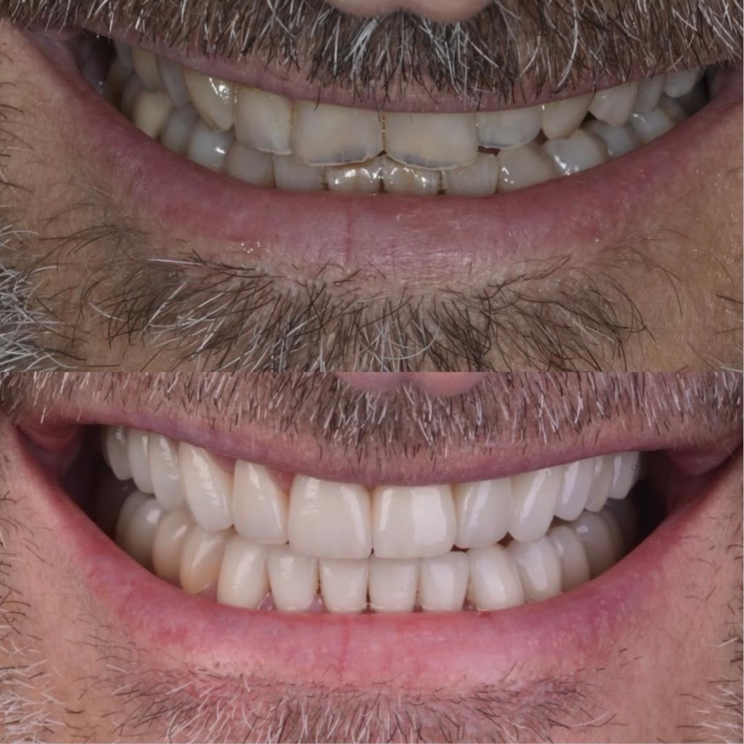 USURE DENTAIRE , BRUXISM & ATM thumbnail