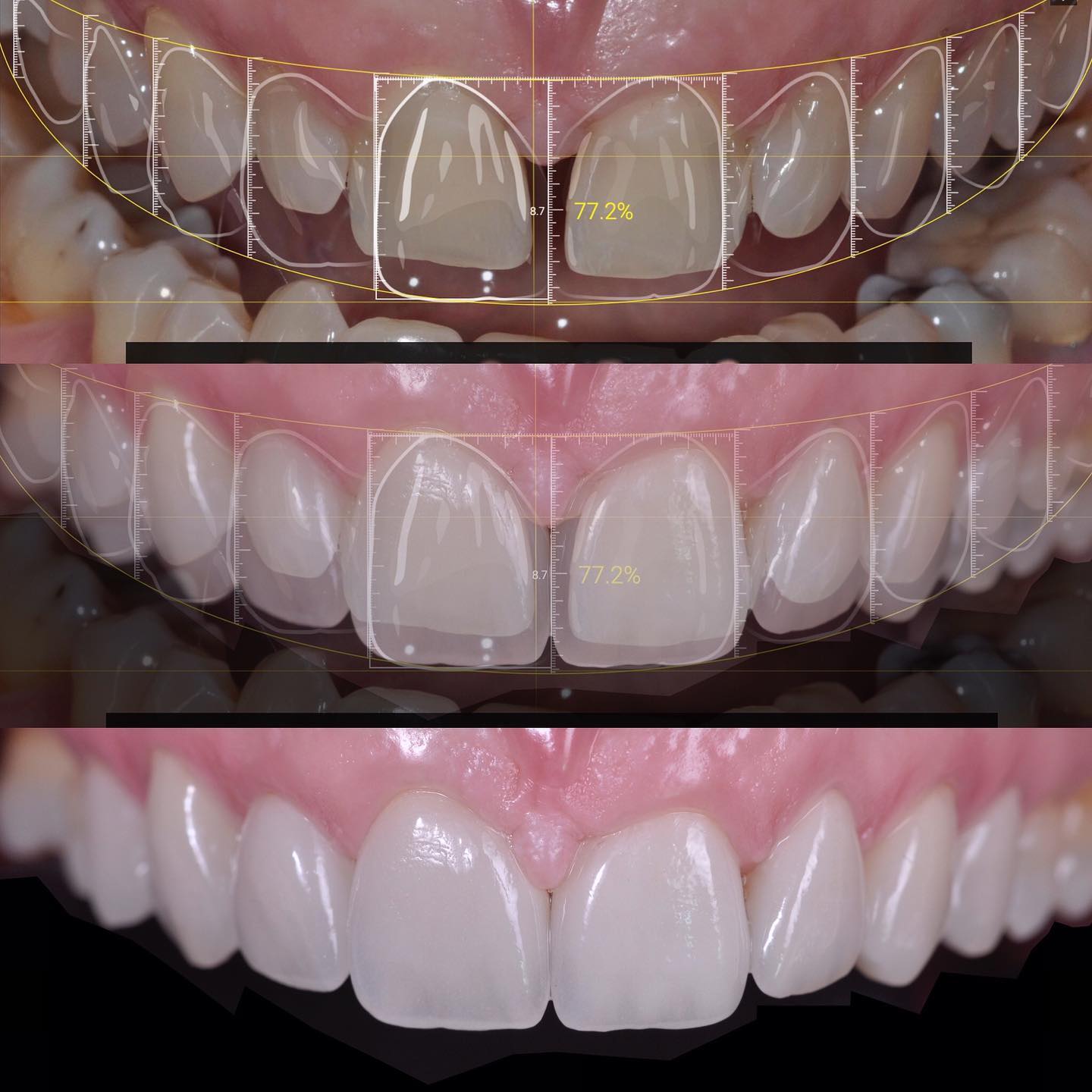 Smile is undoubtedly one of the most important facial features. When teeth start to wear, their length diminishes and th