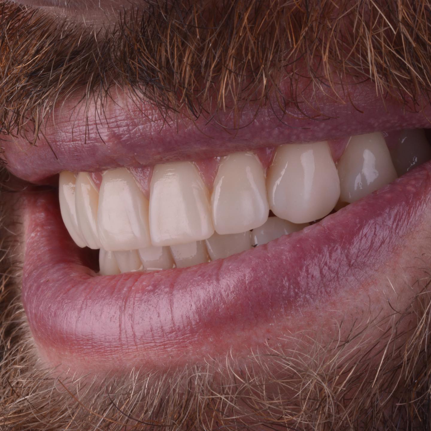 Our last Bonded Functional & Esthetic Prototype. 100 % additive treatment .
Scroll right wise to see more details

#ercu