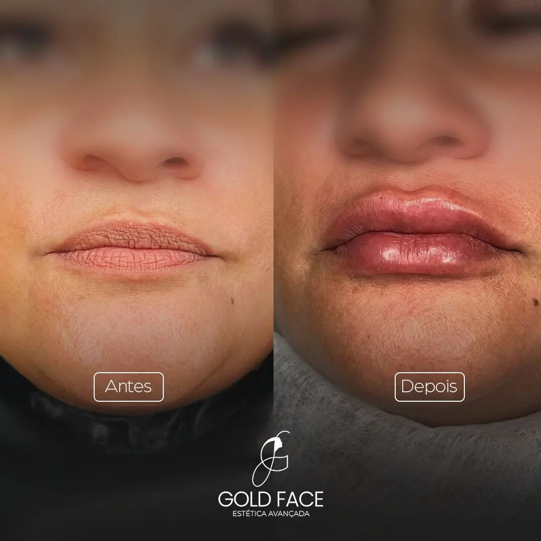 Mais volume, contorno definido e naturalidade que realça a sua beleza! 💋✨ 

Confira o resultado incrível desse preenchim
