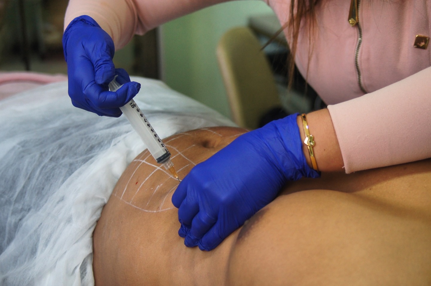 💉O que é Aplicação de Enzimas? 

💉A Aplicação de Enzimas no corpo serve para auxiliar na absorção de gordura. Esse proce