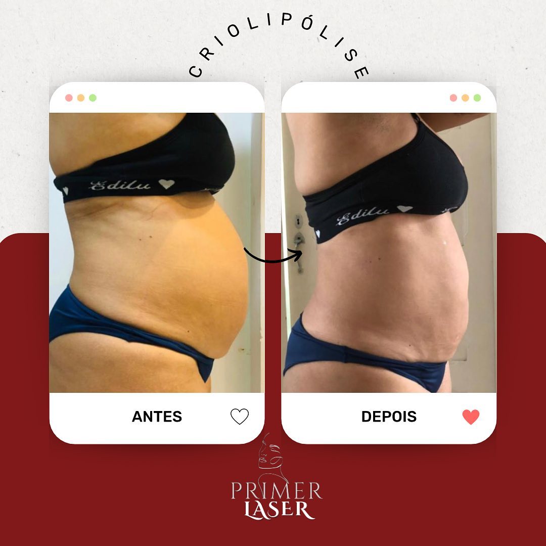 Apenas uma sessão de CRIOLIPÓLISE em abdômen 💎

Os resultados da criolipólise já surgem em 1-2 semanas, sendo algo gradu