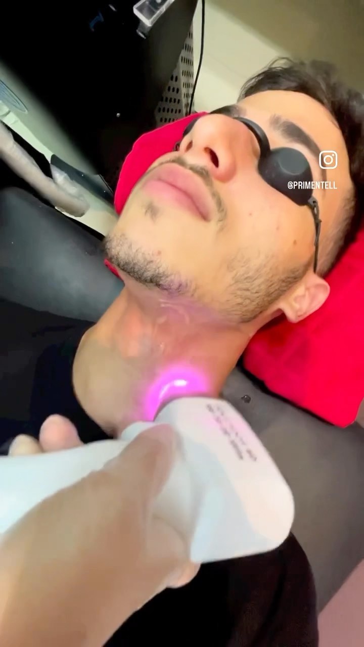 O melhor tratamento para foliculite é a depilação a laser. Com objetivo de remoção de até 90% dos fios, a depilação a la