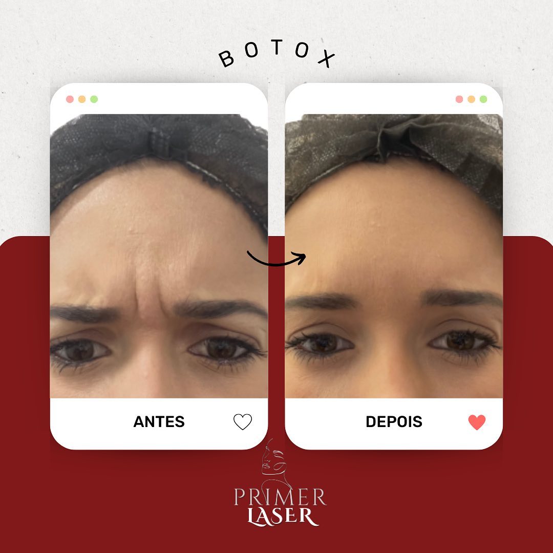 Botox é vida ! ♥️

A toxina botulínica impede a transmissão dos neurotransmissores, assim, impede a contração do músculo