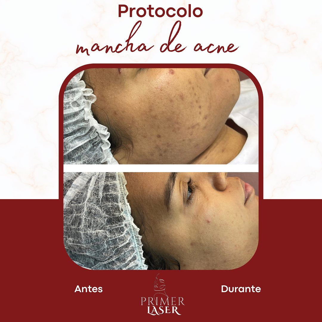 Protocolos personalizados de mancha de acne, acne ativa, cicatrizes de acne, melasma, rejuvenescimento e muito mais…

#e