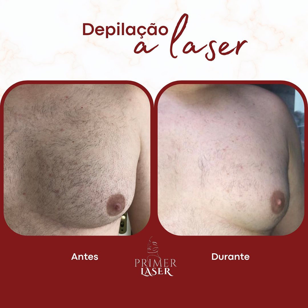 Paciente na quinta sessão de depilação a laser apresentando regiões com falha. Redução de quantidade e espessura.

Agend