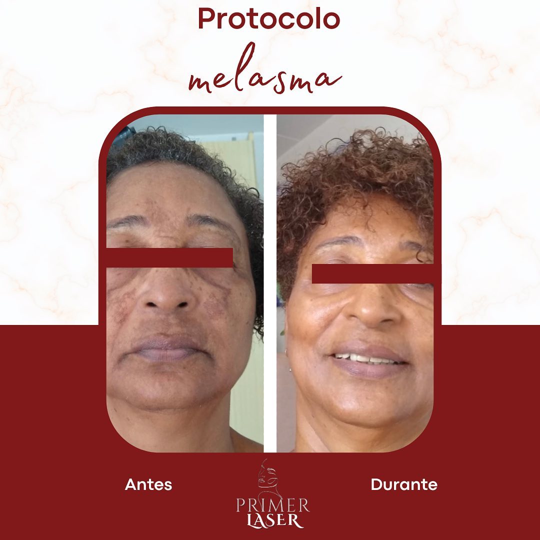 Apesar de não ter cura, melasma tem tratamento sim ! 💎

Vamos agendar sua avaliação?

#esteticafacial #esteticacorporal 
