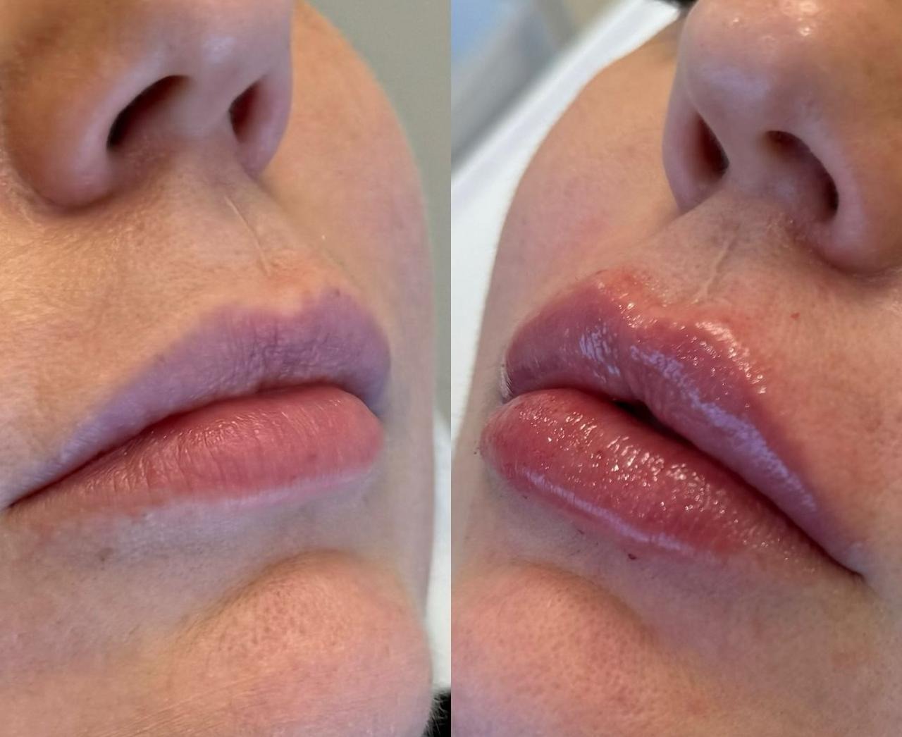 Preenchimento labial thumbnail