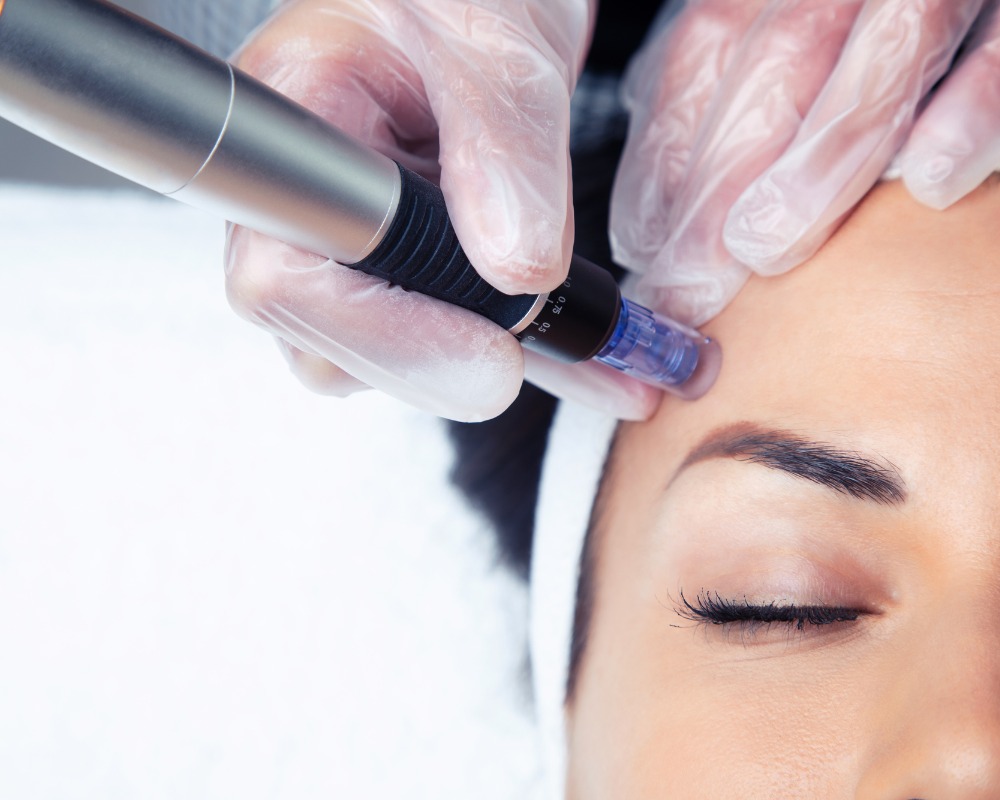 Microagulhamento  thumbnail