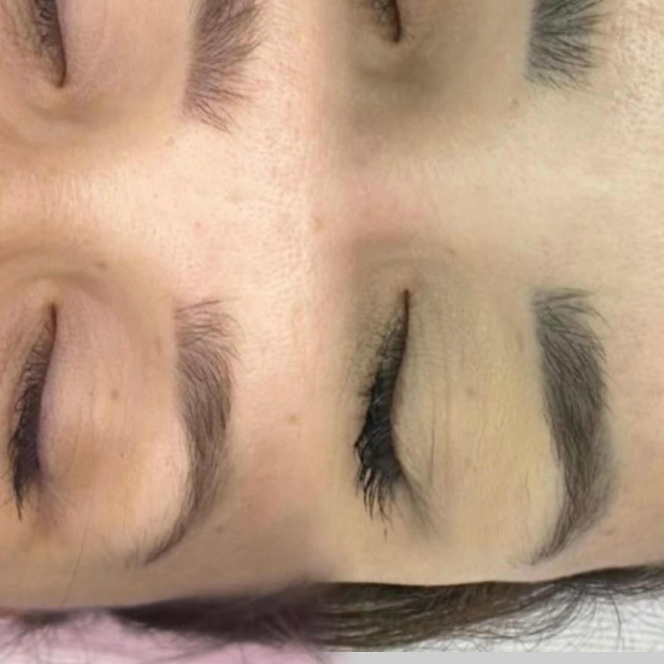 Remoção a Laser thumbnail