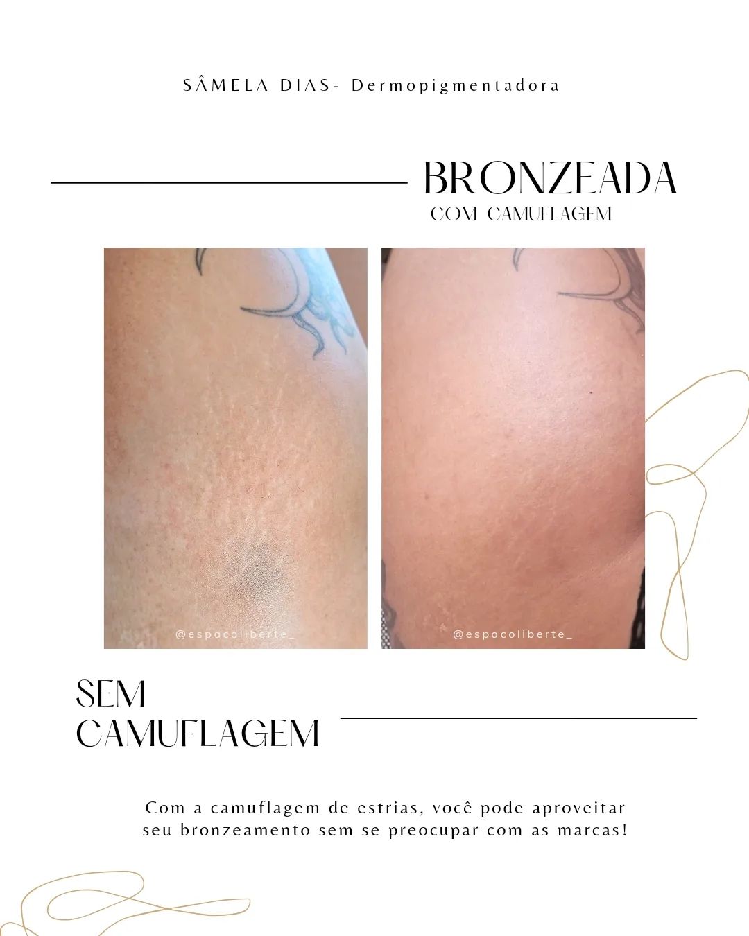 Estrias não combinam com biquínis? 👙
Com a Camuflagem de Estrias elas se tornam apenas histórias de superação escritas n