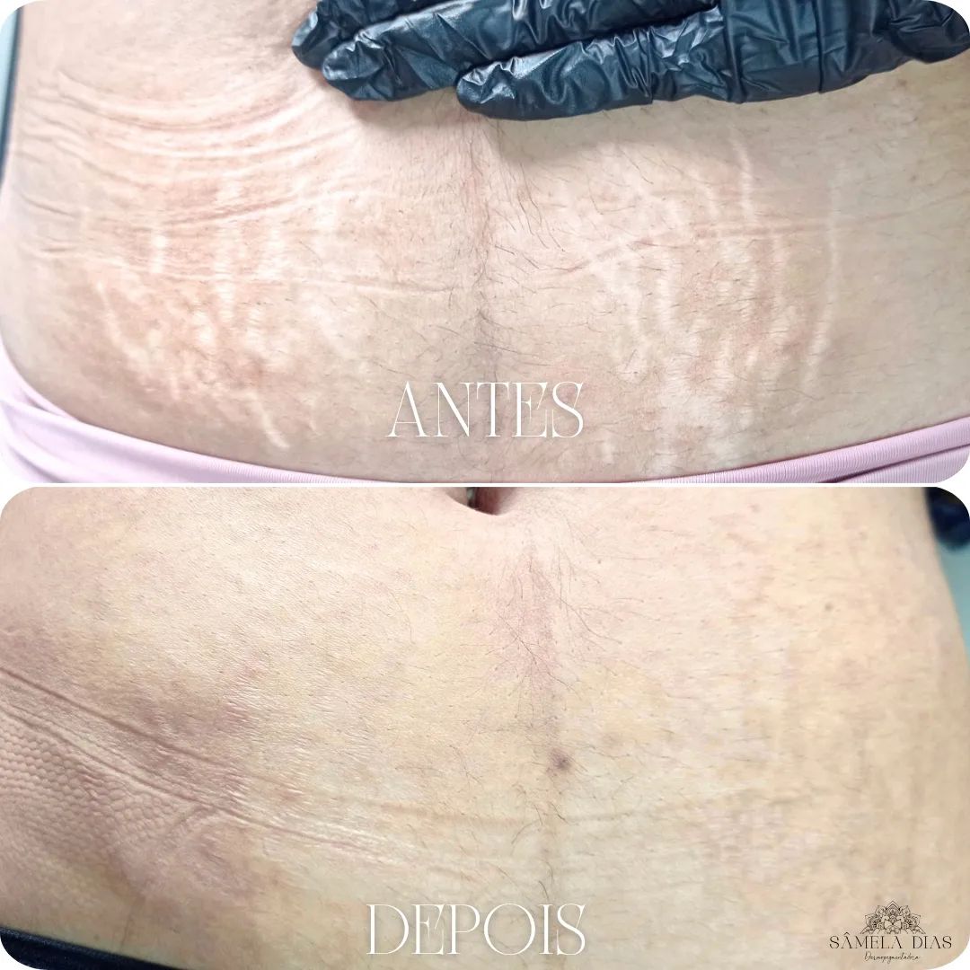 Resultado incrível em apenas 1 SESSÃO! ✨

Você está pronta para transformar sua pele? Confira esse antes e depois de uma