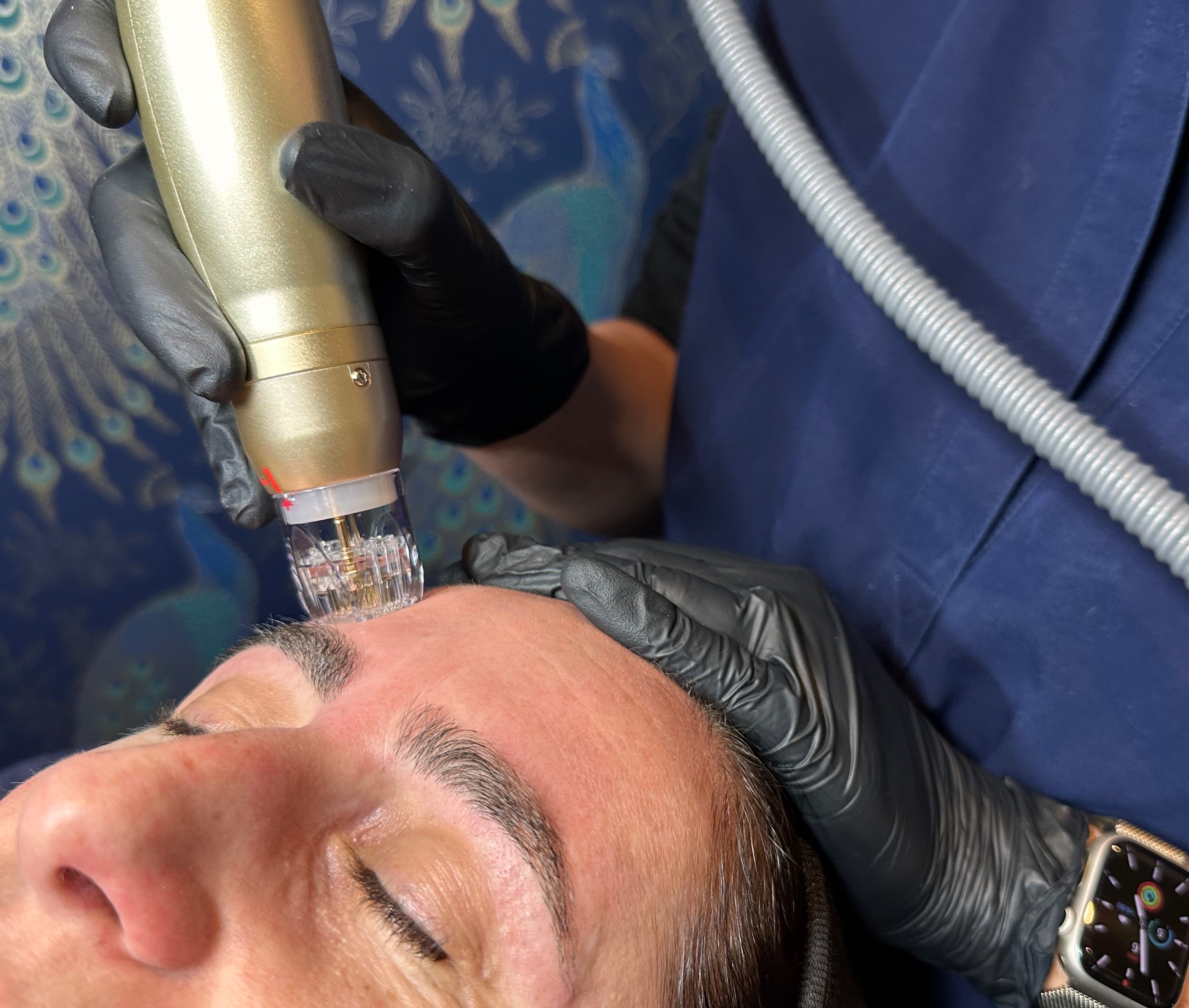 RF Microneedling thumbnail