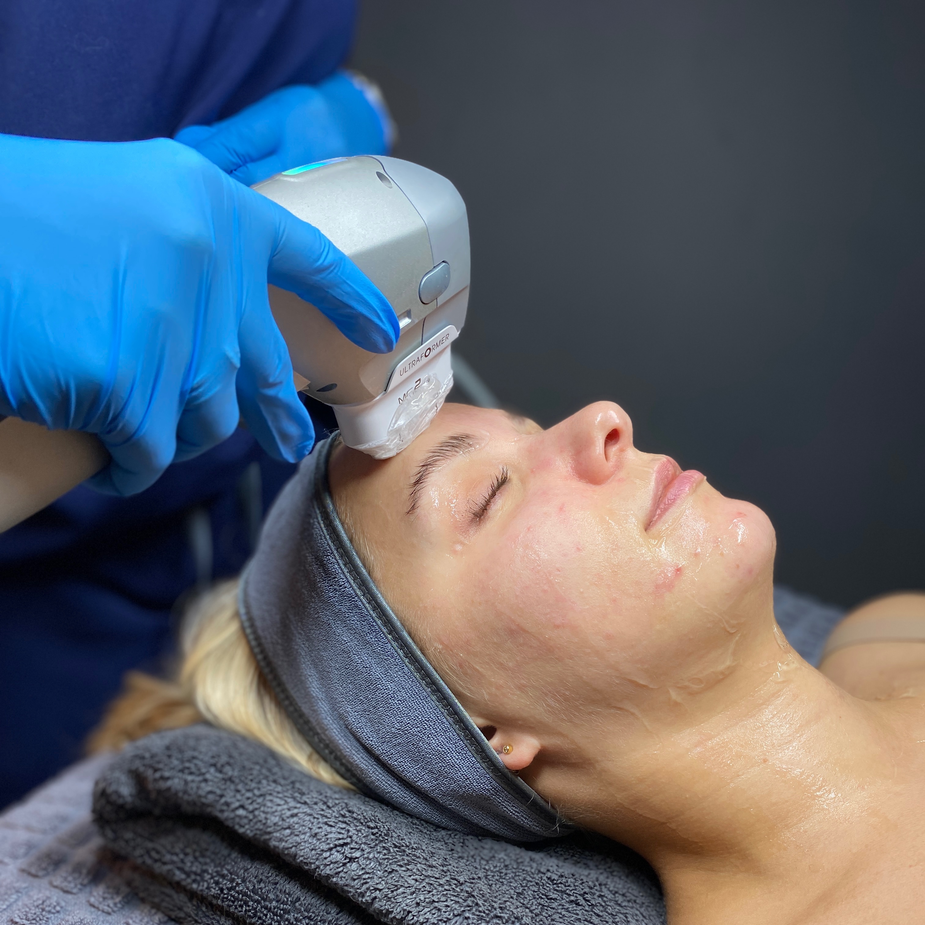 HIFU Non-Surgical Facelift thumbnail