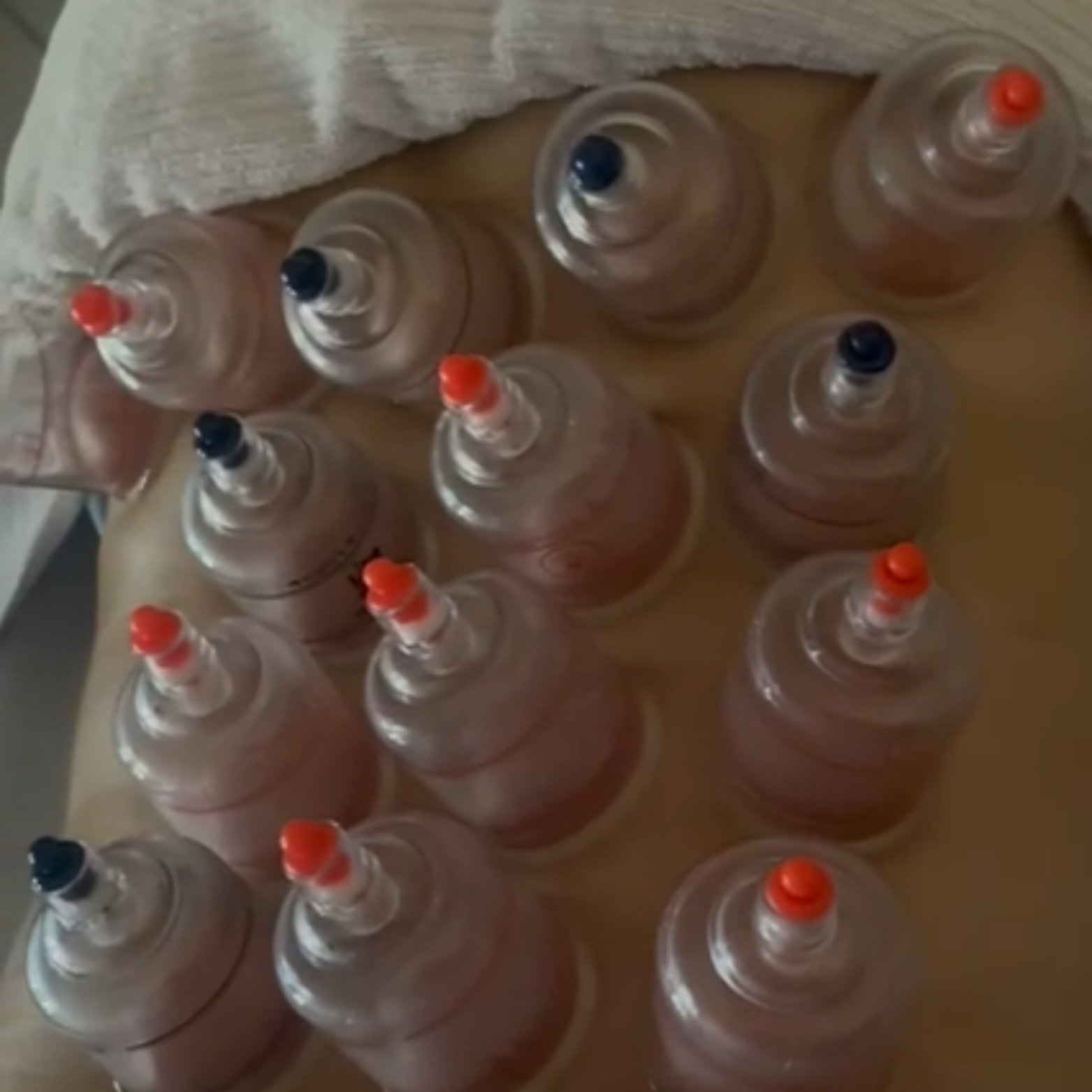 Ventosaterapia thumbnail