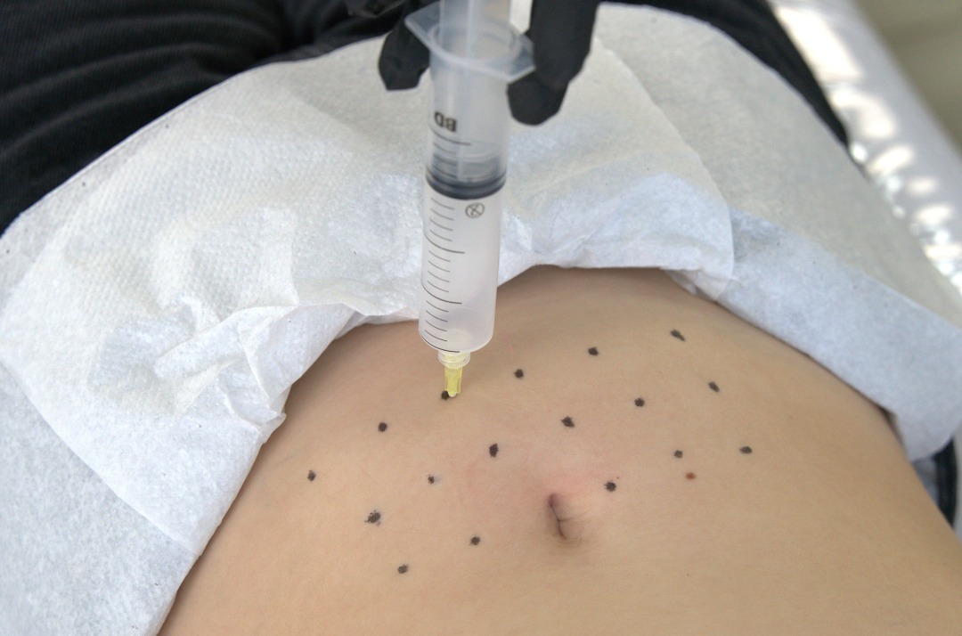 Ozonioterapia thumbnail