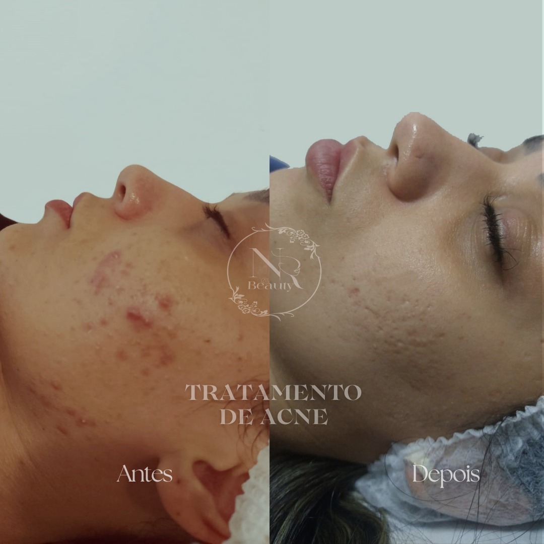TRATAMENTO DE ACNE thumbnail