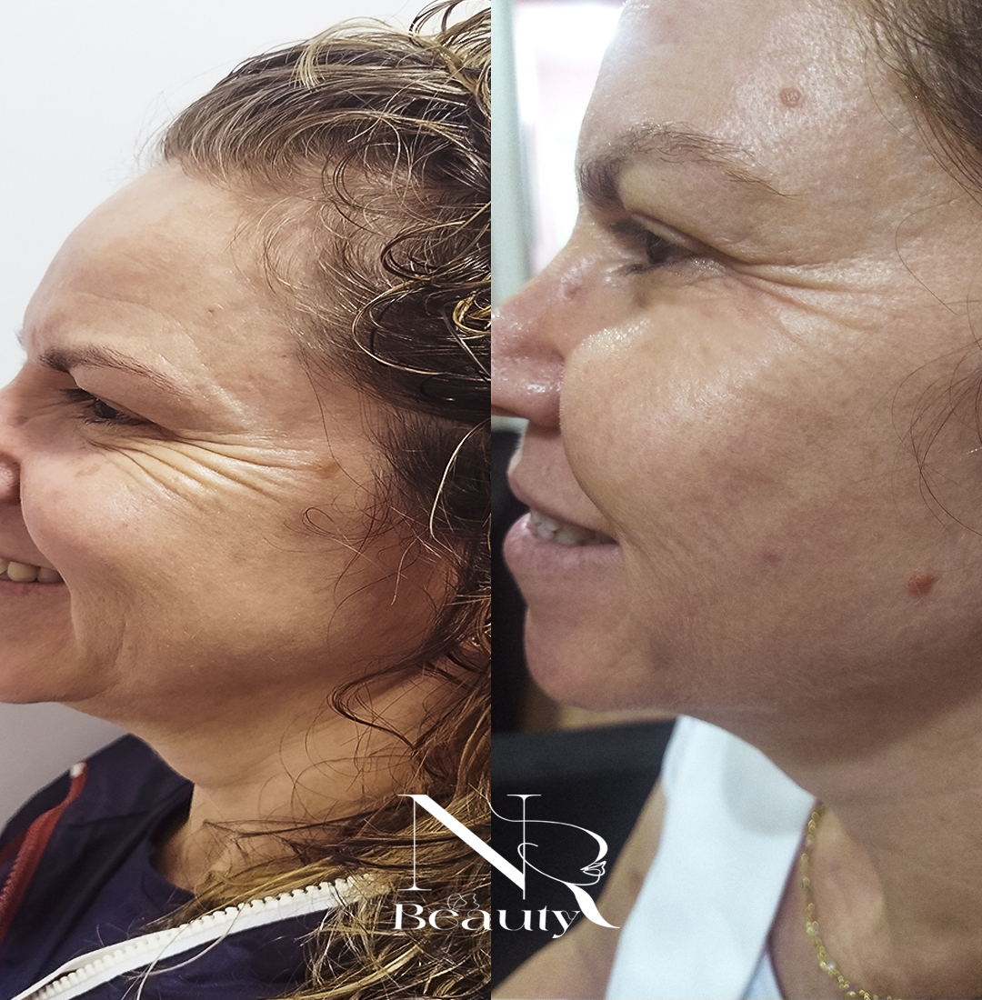 BOTOX NR thumbnail