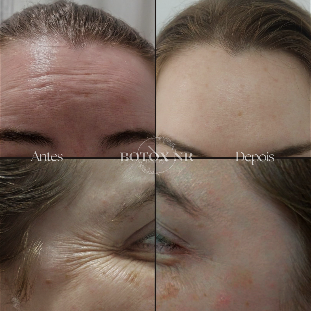 BOTOX NR COMPLETO thumbnail