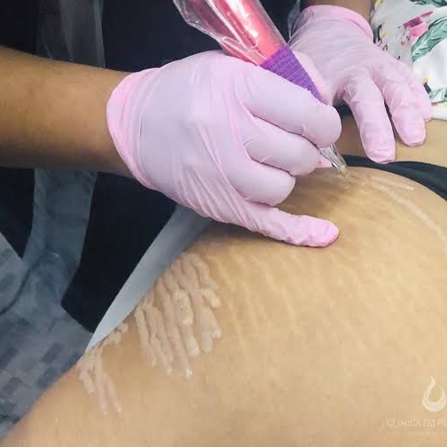 Camuflagem de Estrias  thumbnail