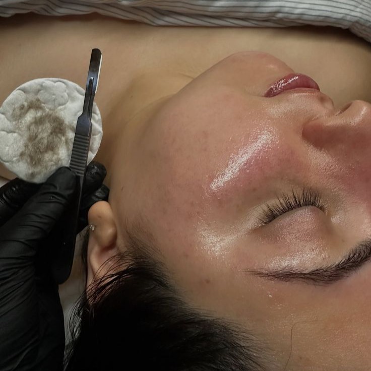 Dermaplaning  thumbnail