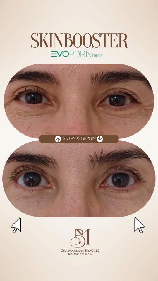 Aquele antes e depois que amamos🥰

Skinbooster EvoPDRN na área dos olhos.

Gostou do resultado? Comente aqui 👇