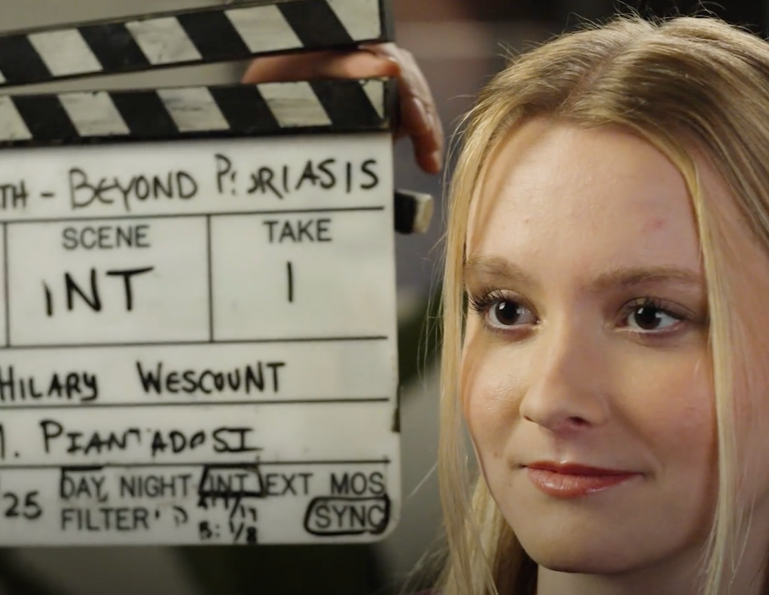 Beyond Psoriasis: Living Through the Flares thumbnail