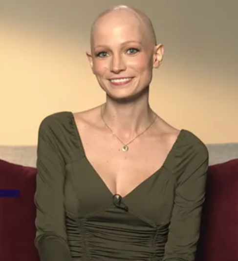 Alopecia Gave Me the Freedom to Be Whoever I Want thumbnail