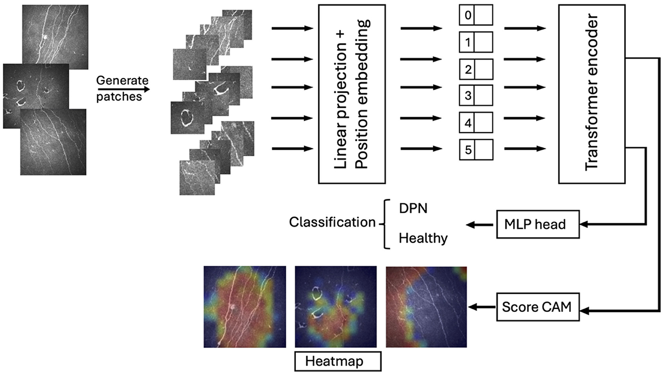 Vision transformers for automated detection of diabetic peripheral neuropathy in corneal confocal microscopy images thumbnail