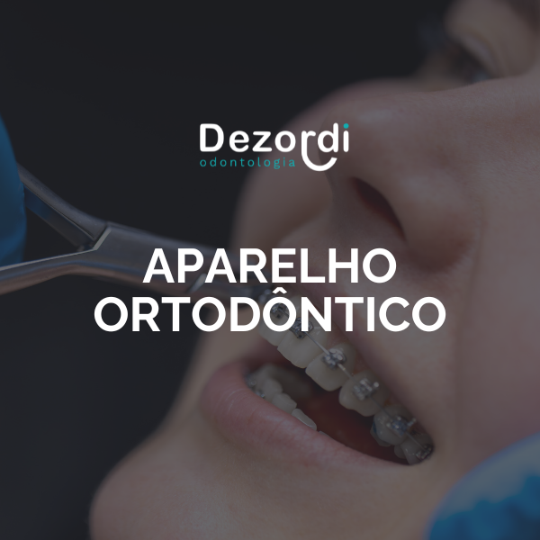 Aparelho ortodôntico thumbnail