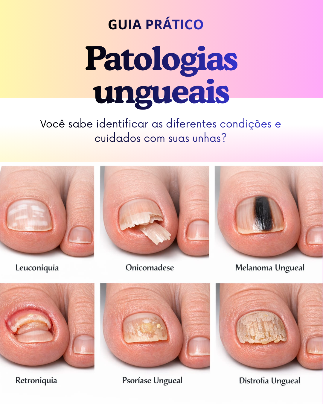 Guia Prático Patologias ungueais/ Tudo o que você precisa saber sobre doenças das unhas thumbnail