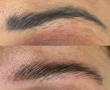 Despigmentação  thumbnail