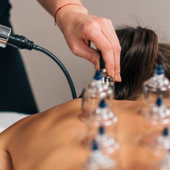 Ventosaterapia  thumbnail