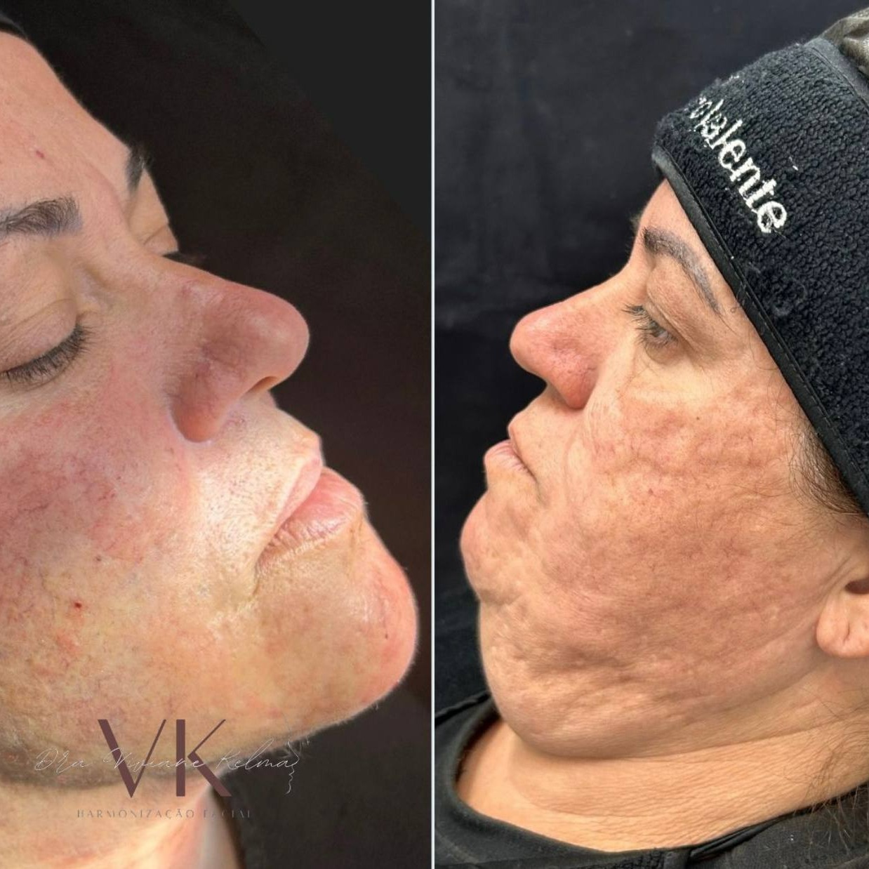 LipoEscultura Cervico Facial LFC 4D em Recife thumbnail